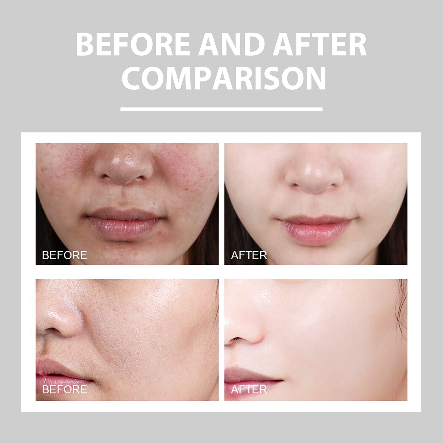 Eelhoe Brightening Acne Repair Cream — Hydrating & Redness Relief