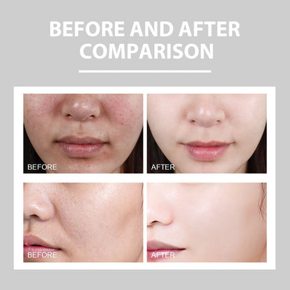 Eelhoe Brightening Acne Repair Cream — Hydrating & Redness Relief